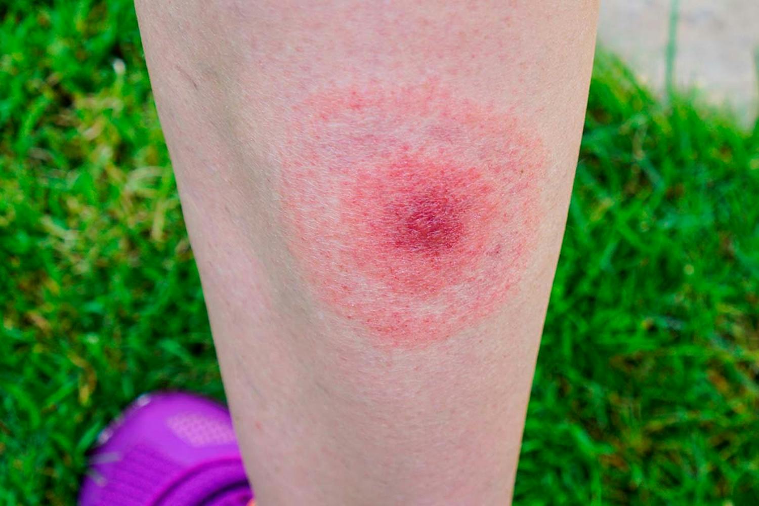 Fästing sjukdom Borrelia fästing